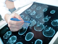 shRNA Based Gene Therapy Prevents Neurodegeneration in Rat Model